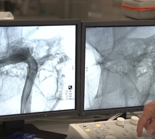 U Beranama urađena intervencija na mozgu kod pacijenta u budnom stanju